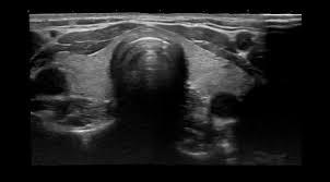 Ultraschallbild mit einem gut sichtbaren, runden, dunklen Bereich in der Mitte, vermutlich eine knotige Struktur oder ein Lymphknoten in der Schilddrüsenregion