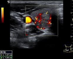 Farbdoppler-Ultraschallbild eines knotigen Bereichs mit markierten Messpunkten und erkennbarer Durchblutung in Rot und Gelb