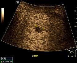 Kontrastmittelverstärkte Ultraschallaufnahme (CEUS) eines Organs mit markierter Läsion