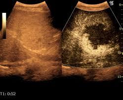 Zwei kontrastmittelverstärkte Ultraschallbilder eines Organs