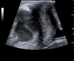 Ultraschallbild mit typischer Darstellung des Gastrointestinaltrakts